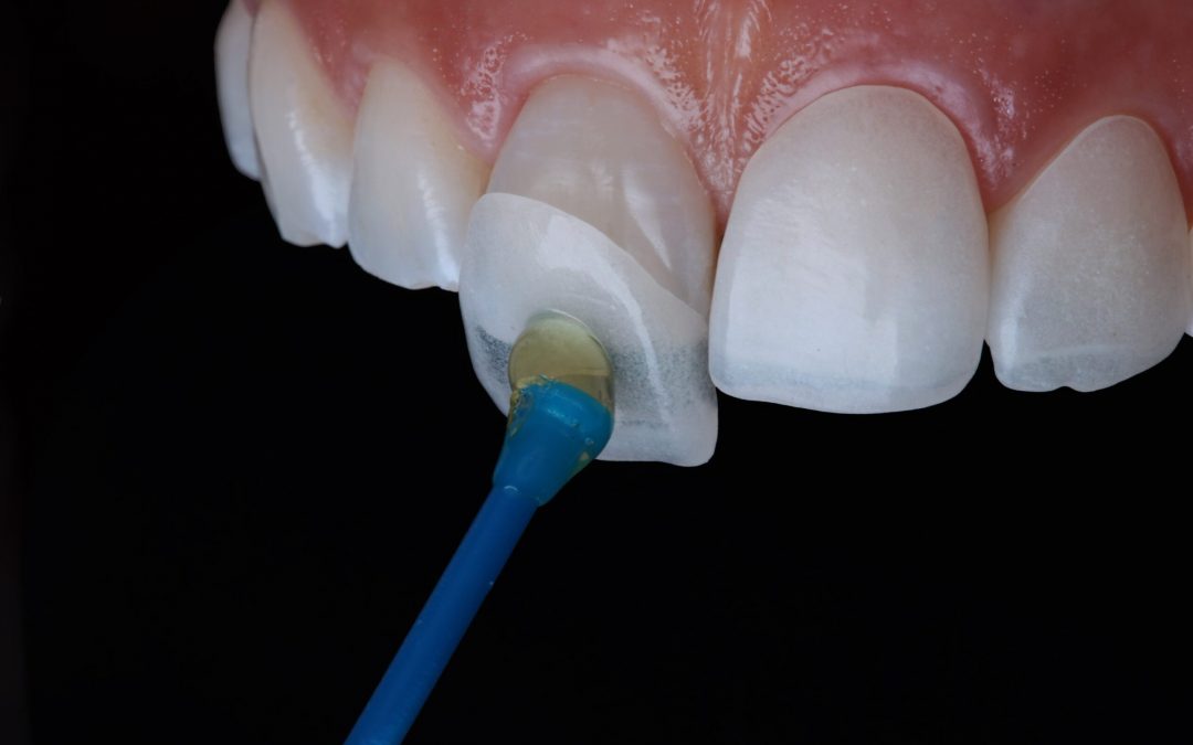 Porcelain Veneers: Benefits, Risks & Alternatives