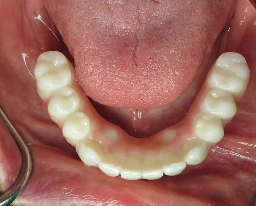 All On 4 Dental Implants: Pain and Risks